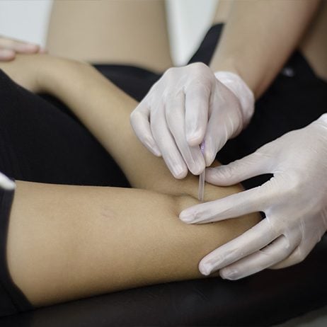 Physiotherapy - IMS - Intramuscular stimulation